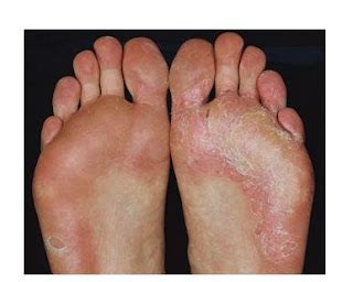 Tinea pids ( Athlete's foot ) -Symptoms, treatment and prevention ...