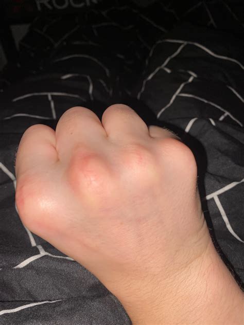 Is my knuckle broken : r/InjuriesAndWounds