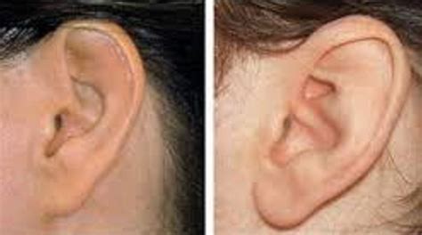 Are Your Ear Lobes Attached? | The-Health-Focus by Quantum Healing Institute