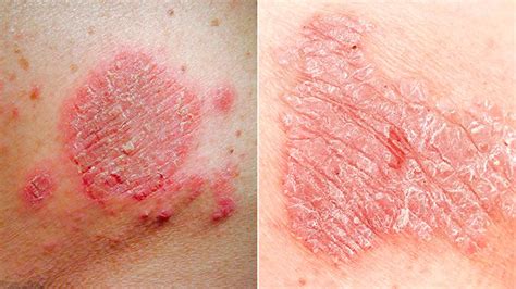 8 Causes for a Red Patch Skin & Fast Things to Do About It Today • Chick About Town