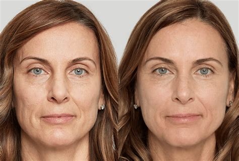 SCULPTRA | Bergstrom Aesthetics