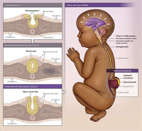 Spina Bifida | NEJM