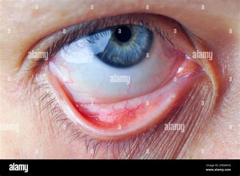 Female eye and Conjunctival sac. Instill eye ointment or eyedrop concept Stock Photo - Alamy