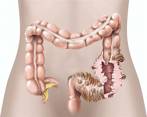 How To Treat Diverticulitis At Home - A liquid diet is recommended to apply during the time of ...