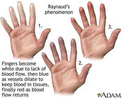 Raynaud's phenomenon: MedlinePlus Medical Encyclopedia Image