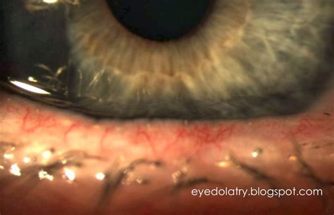 Telangiectasia Eyelid