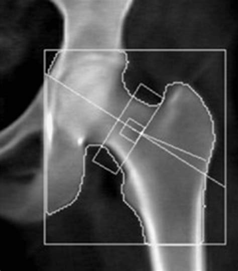 Exogenous Cushing Syndrome and Hip Fracture Due to Over-the-Counter ...