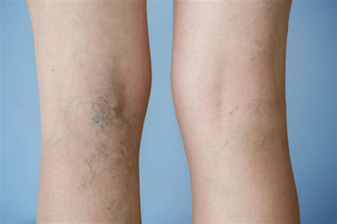 What Causes Spider Veins on Your Legs? - Reno Sparks Medspa