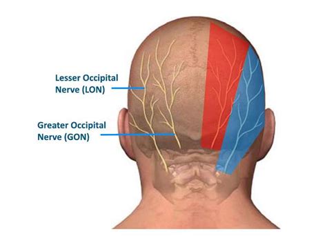 Occipital Neuralgia: Symptoms, Diagnosis, and Treatment