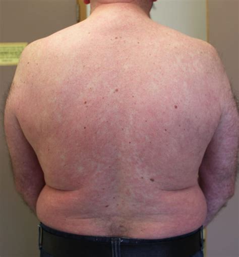 Cutaneous Lymphoma Skin Rash