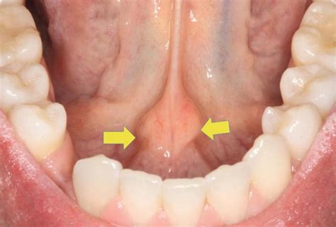 Salivary Gland Diseases | Pocket Dentistry