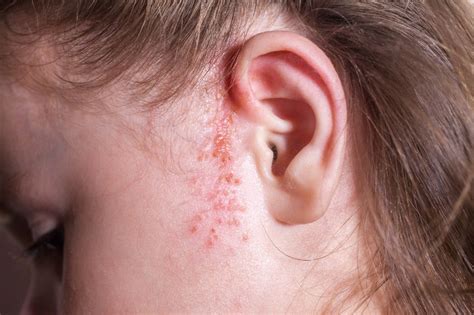 The Symptoms, Causes, Treatment and Prevention of Impetigo - Page 2 of 5 - HealthVibe