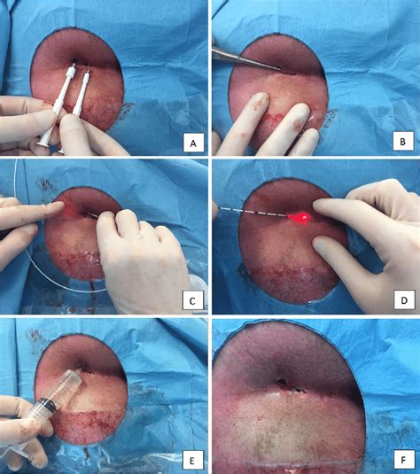 SiLaC® procedure with radial diode 1470 nm probe for pilonidal disease ...