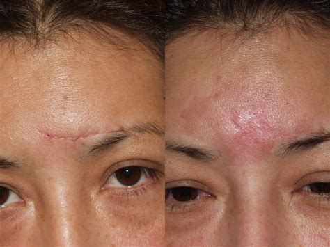 Before & After Pictures | Scar Revision Chicago, IL |Dr. Sidle