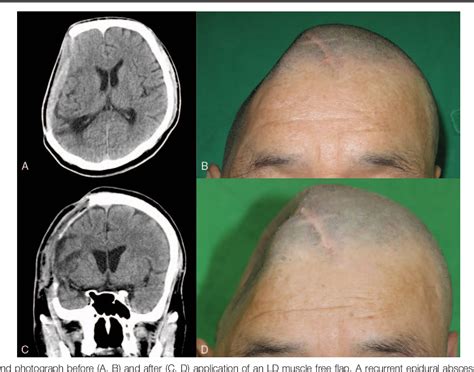 Craniotomy Craniectomy Essential Brain Surgery Chicag - vrogue.co