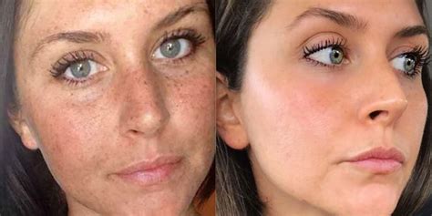 This Woman’s Reddit Before-And-After Sun Damage Photo Is Going Viral