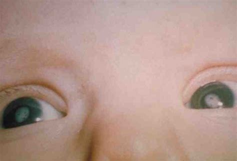 Congenital cataract - types, causes, features, treatment • DNB Pediatrics