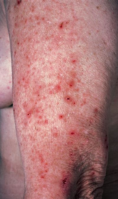 Dermatitis Herpetiformis