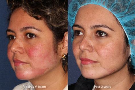 Treating Rosacea with IPL - Cosmetic Laser Dermatology Skin Specialists ...