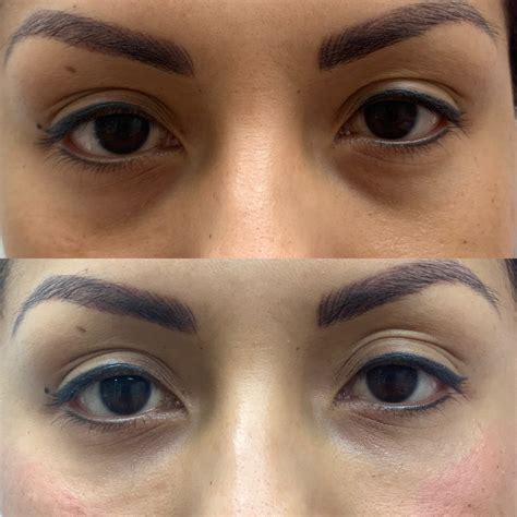 Eye Filler: Real Patient Photos and What to Expect