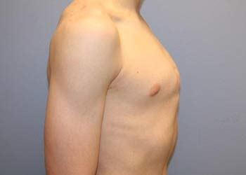 Pectus Carinatum Brace Before And After