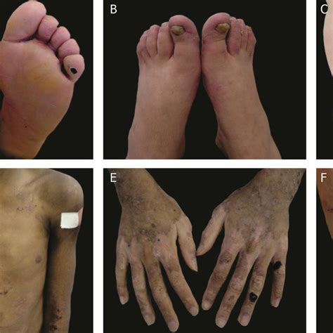 Clinical subtypes of junctional epidermolysis bul- losa (JEB ...