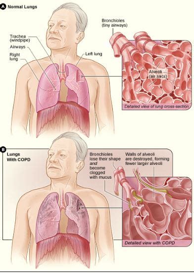 Chronic Obstructive Pulmonary Disease (COPD): Understanding Causes ...