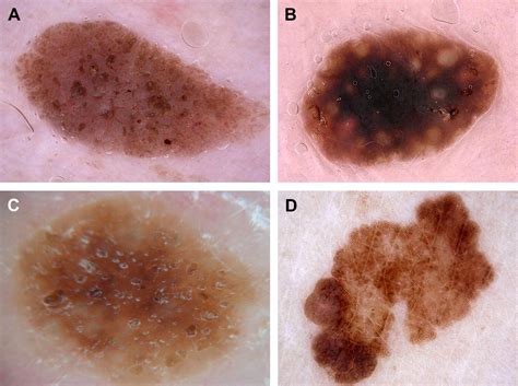 Dermatoscopy for Melanoma and Pigmented Lesions - Dermatologic Clinics