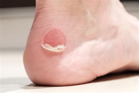 School Shoes Causing Blisters? – Umina Podiatry