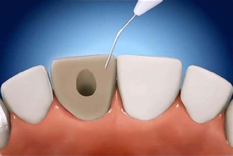 Endodontic Care – Medema Endodontics – Experts in Saving Teeth