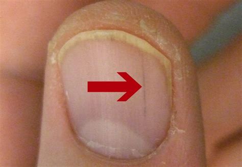 I can't believe how many disease can be identified early just by looking at your fingernails ...