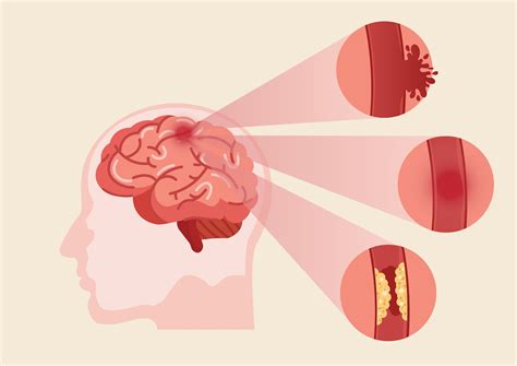 What Happens Right Before A Stroke? Here Are 5 Warning Signs