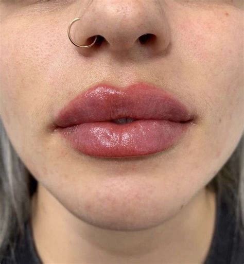 Pin by pauli esteche on quiero | Lip fillers, Botox lips, Lip augmentation