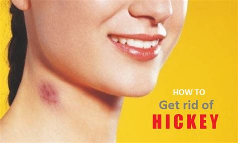 Get Rid of Hickeys on Neck, Lips, Chest Fast Overnight