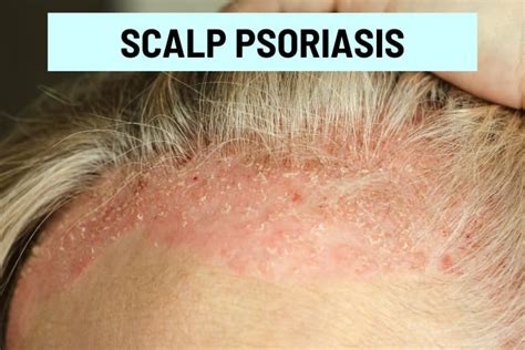 Red Spots on Scalp: 11 Causes, Pictures and Treatment