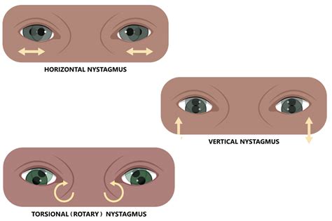 Nystagmus Symptoms Causes Treatment Options Explained - vrogue.co