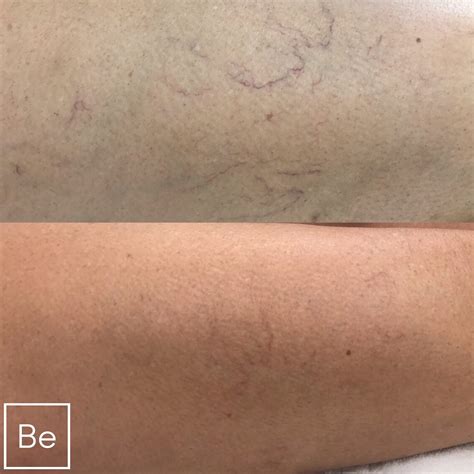 Spider Vein Laser Treatment in Rochester, NY | Bare Element