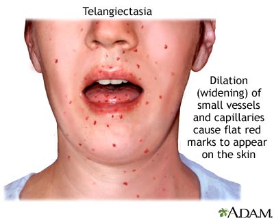 Ataxia - telangiectasia Information | Mount Sinai - New York