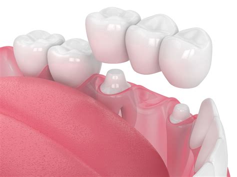 Livonia Dentist Uses A Bridge To Treat Minor Tooth Loss | Livonia, MI