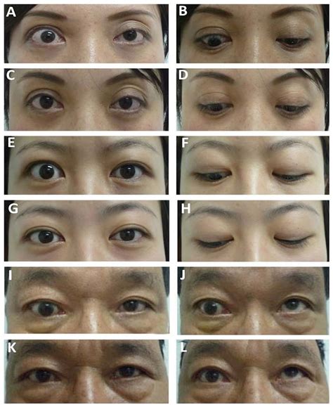 Thyroid-associated ophthalmopathy signs in patients are improved after... | Download Scientific ...