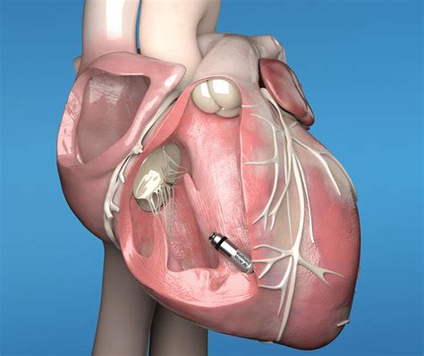 Dual Chamber Pacemaker Ecg