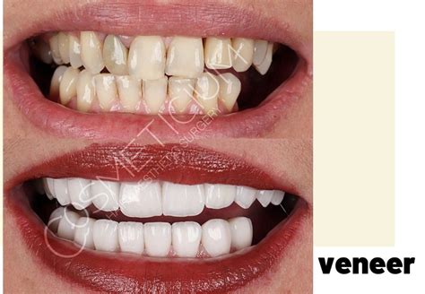 Veneers in Turkey: Affordable Cost Smile Makeover - Cosmeticium