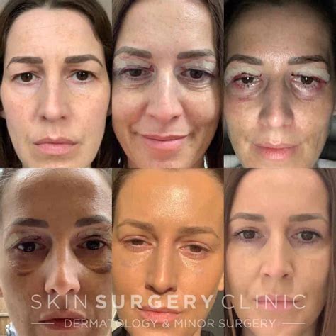 Kelsey's experience having Upper Blepharoplasty Eyelid Lift Surgery - Skin Surgery Clinic