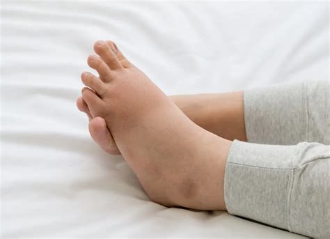 Swollen foot during pregnancy | Podexpert