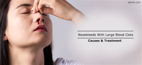 Nosebleeds With Large Blood Clots - Causes, Treatment, When To See A Doctor