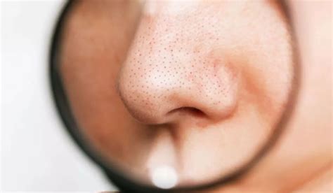 Best Blackhead Removal Tools For Instant Results You Should Try!