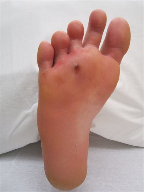 Foot Puncture Wound | Immunization Info