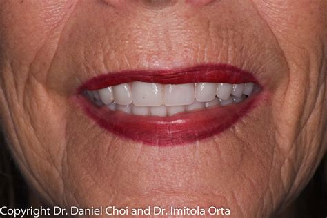 Snap-In Dentures | North Texas Dental Surgery