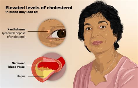 High Cholesterol Symptoms