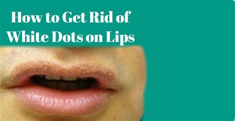 How to Get Rid of White Dots on Lips Using Home Remedies